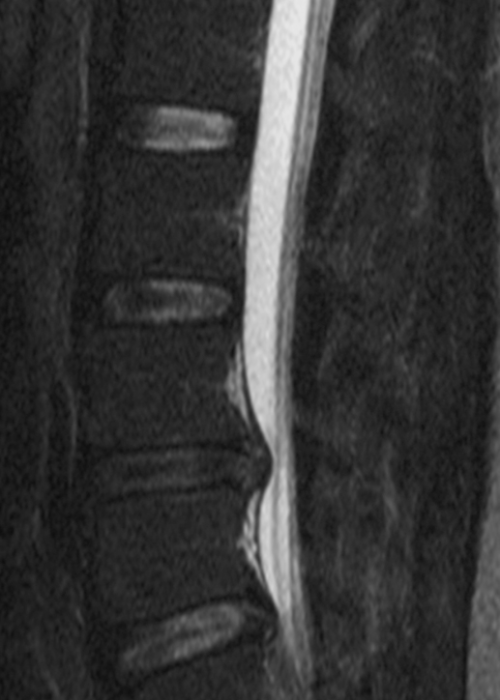 herniated disc image - sciatica stretches