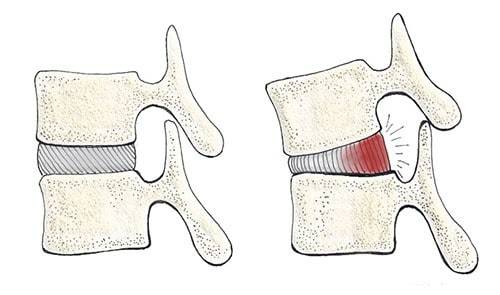 herniated disc and posterior pelvic titlt