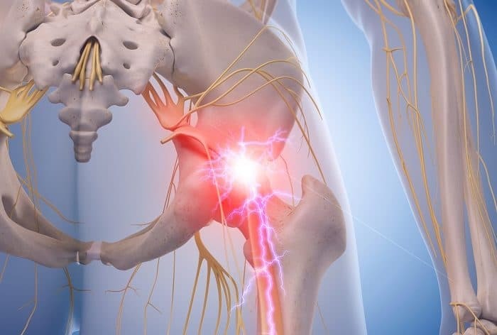 piriformis syndrome stretches sciatica
