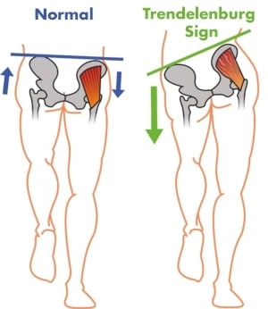 gluteus medius weakness and trendelenburg sign