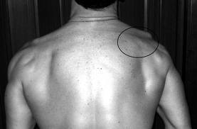 scapular dyskinesis - type 3