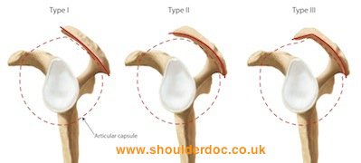 subacromial impingement - acromion types