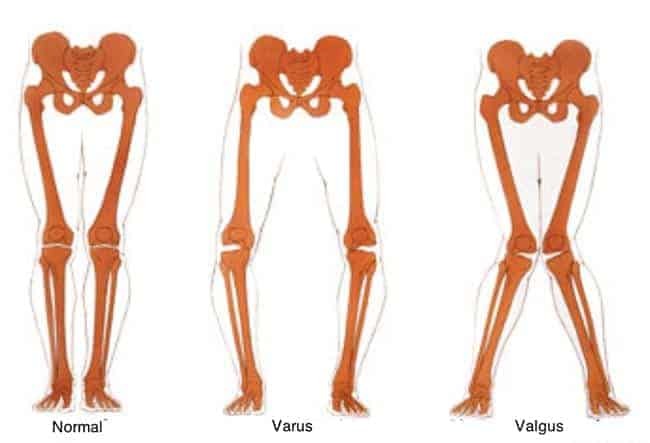 valgus knees and weak gluteus medius