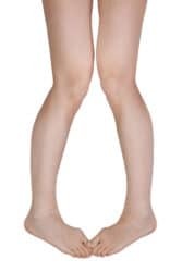 patellar-tracking-disorder-knock-knees
