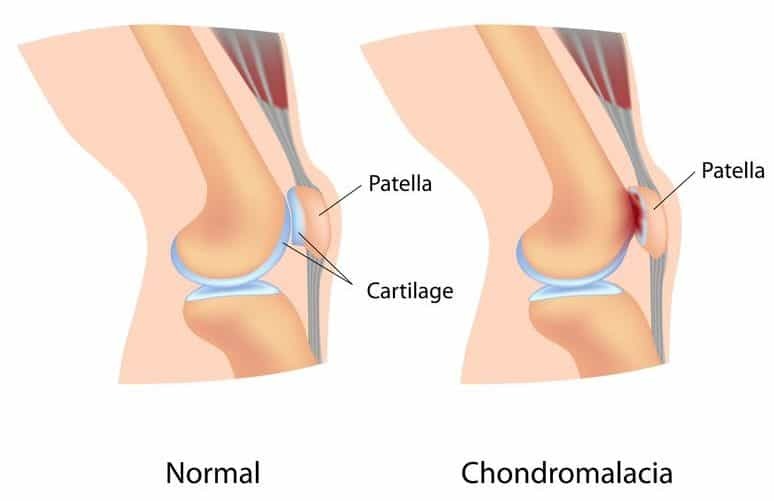 patellofemoral pain syndrome exercises - Chondromalacia