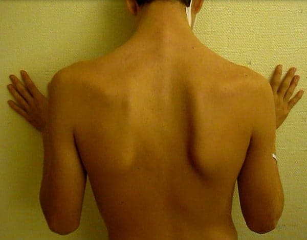 scapular dyskinesis - winged scapula