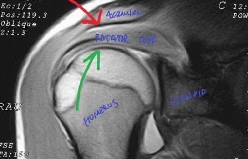 shoulder impingement stretches