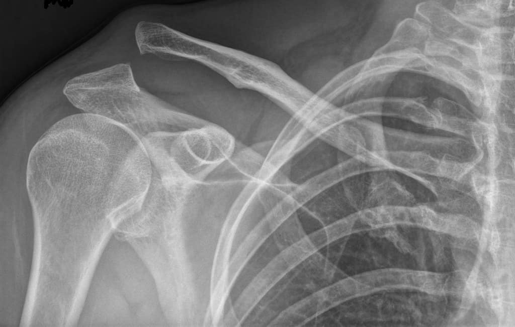 sprained ac joint xray