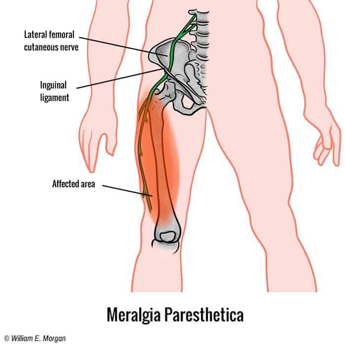 meralgia paresthetica pillow