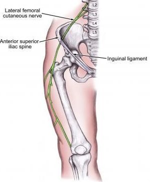 meralgia paresthetica pillow