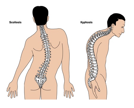  scapular stabilization exercises kyphotic thoracic spine spine deformities, hunchback