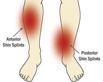 Shin splints: also known as medial tibial stress syndrome, overpronation and a pronated foot posture showed strong evidence as a risk factor as outlined in this 2014 study. 