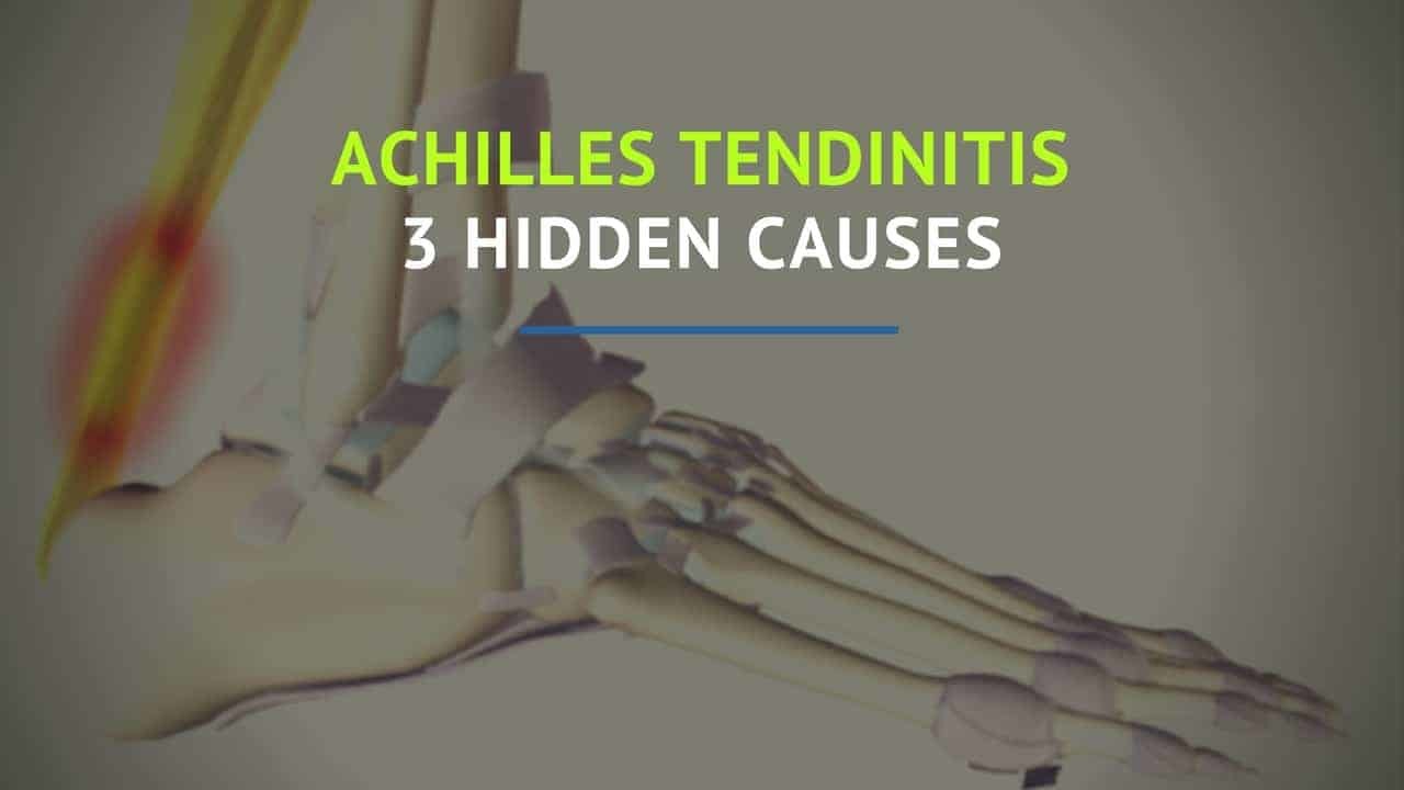 Achilles' Heel, Jared's Neuroma - Chapelboro.com