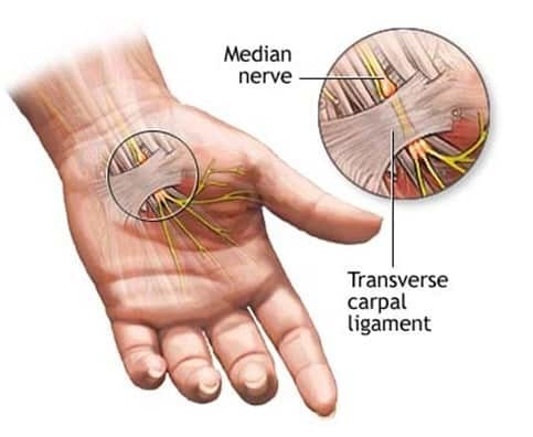 carpal tunnel symptoms median nerve