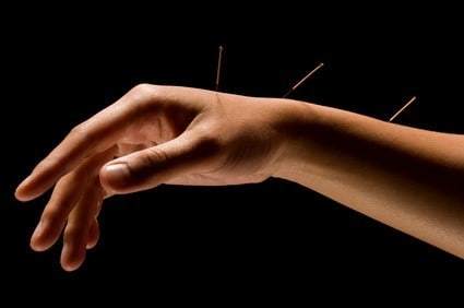treat carpal tunnel symptoms using acupuncture
