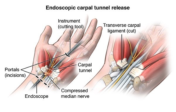 treat carpal tunnel symptoms using an endoscopic release