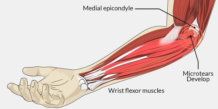 wrist flexor muscles and golfers elbow treatment