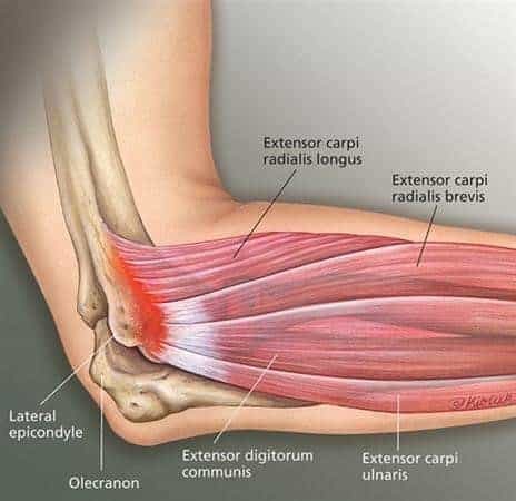anatomy pic - how to heal tennis elbow