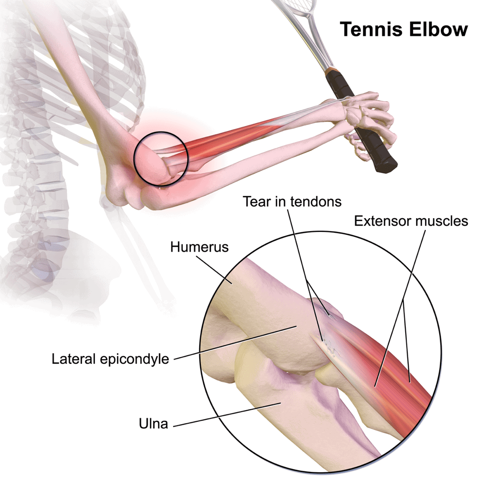 lateral epicondylitis exercises - anatomy