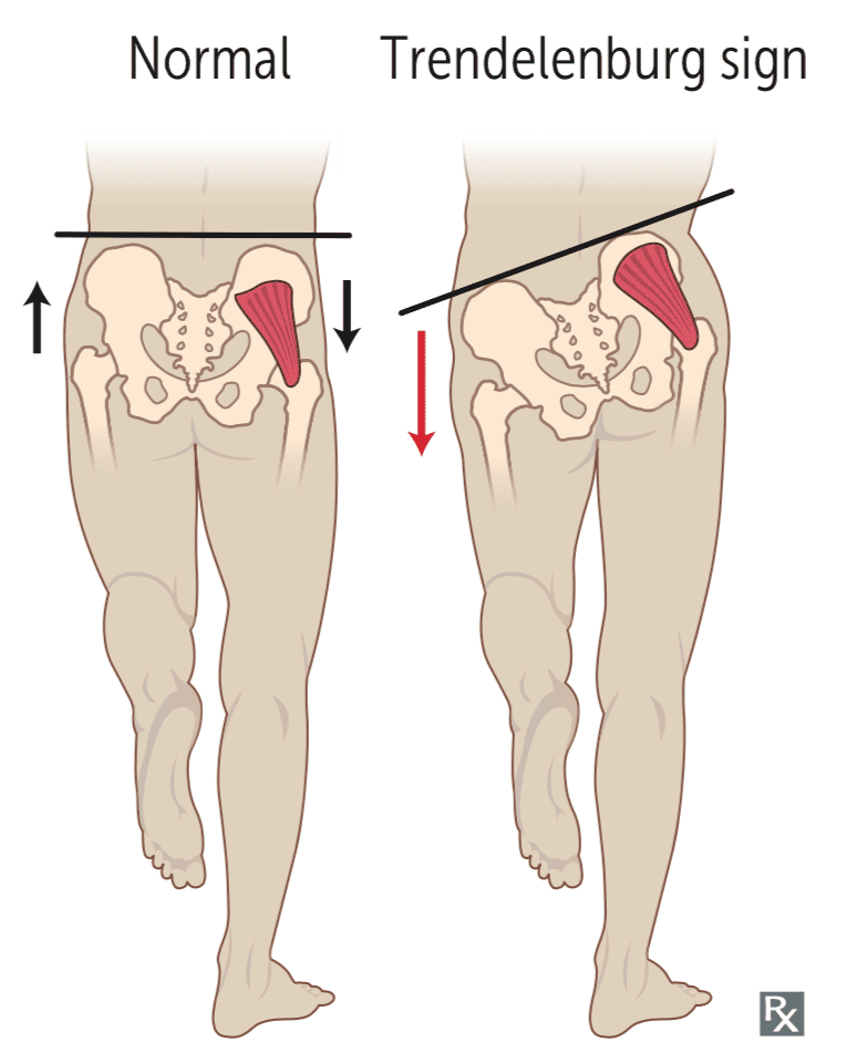 trendelenburg sign - exercises to strengthen the glute medius