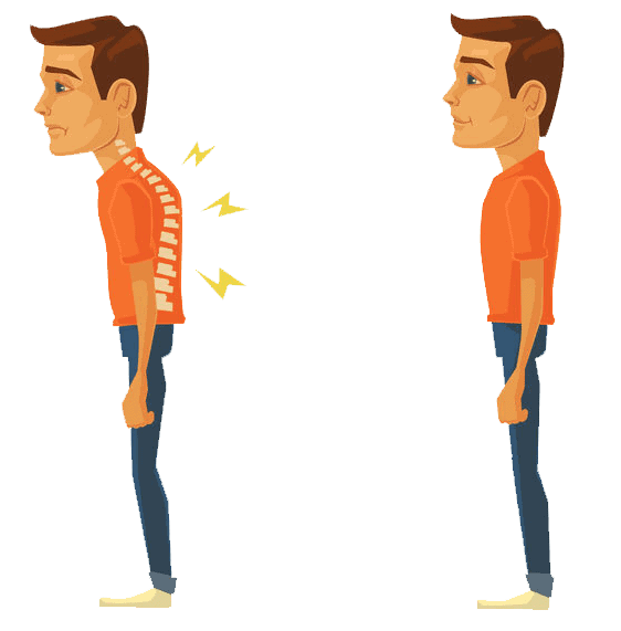 how to fix hunchback posture or kyphosis