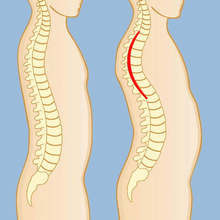 hunchback posture
