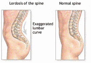 lumbar spine lordosis