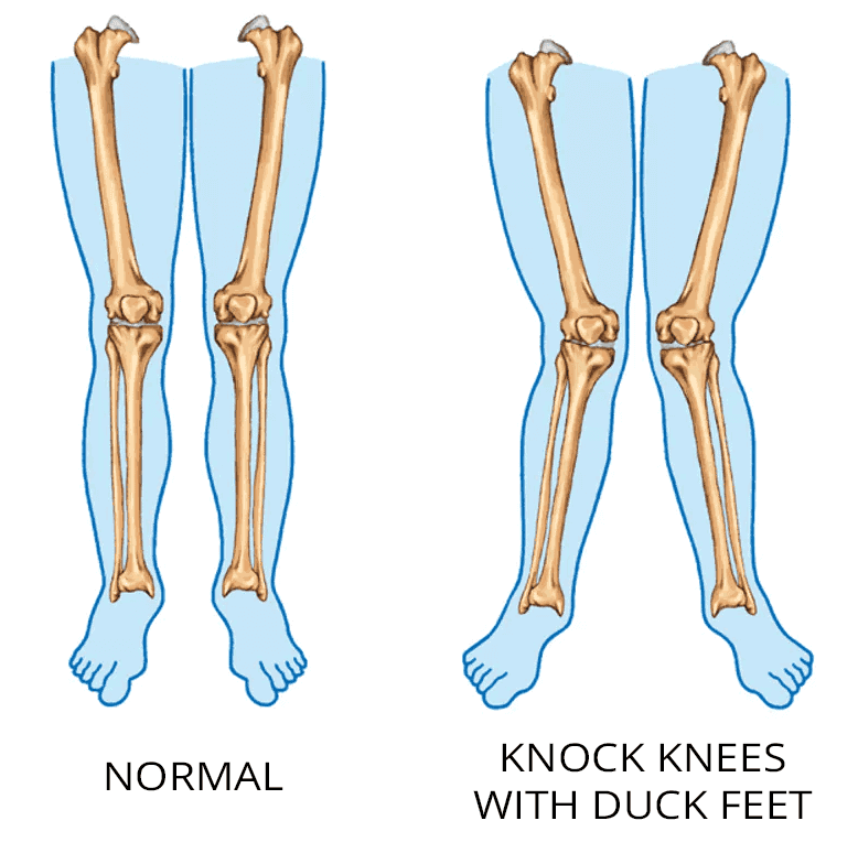 Tensor fasciae latae pain issues associated with valgus (knock) knees