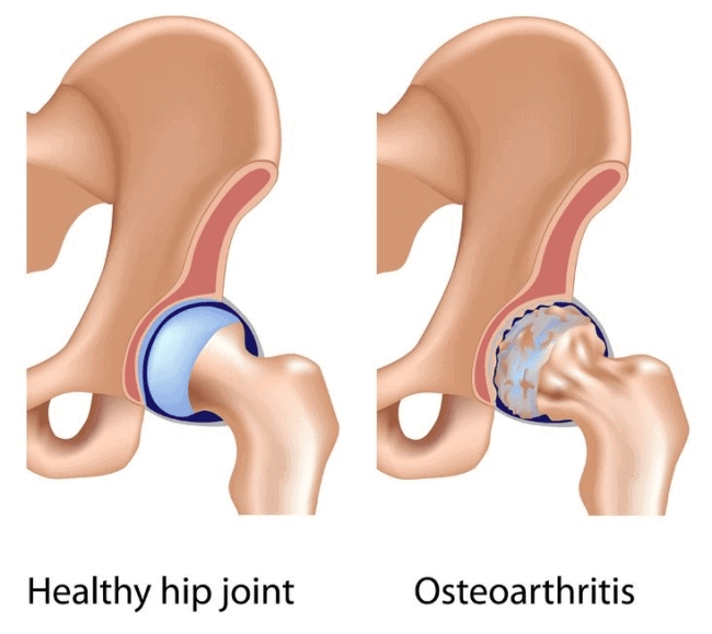 tfl pain issues associated with hip osteoarthritis