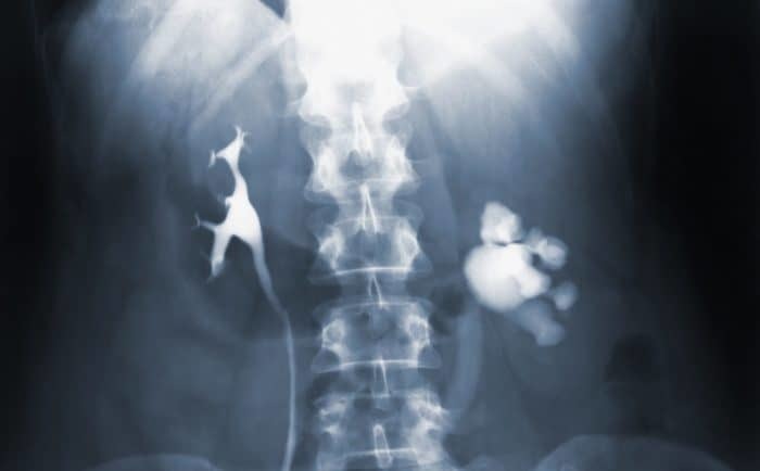 spine-xray