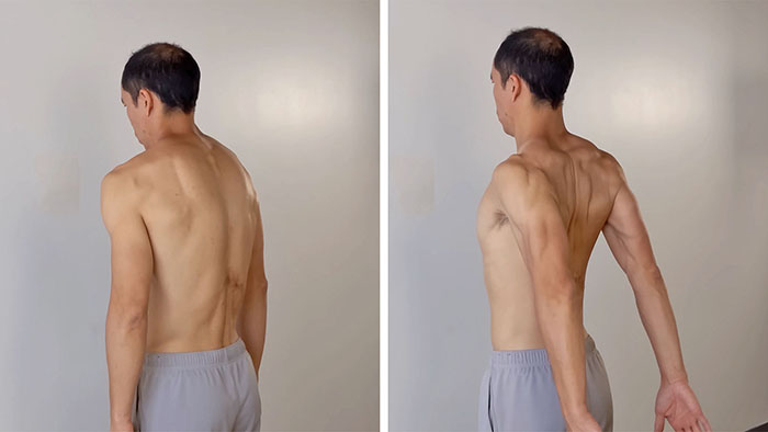 dis shoulder extension anterior scapular tilt - serratus anterior