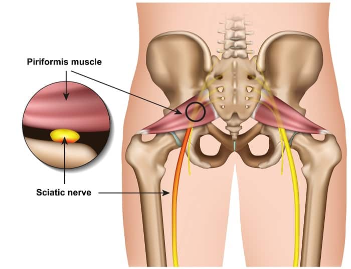 piriformis syndrome vs sciatica