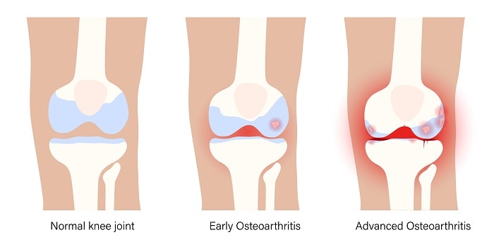 stages of bone on bone knee arthritis