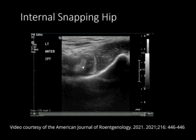 4 Snapping Hip Syndrome Exercises (Plus Psoas Strengthening)