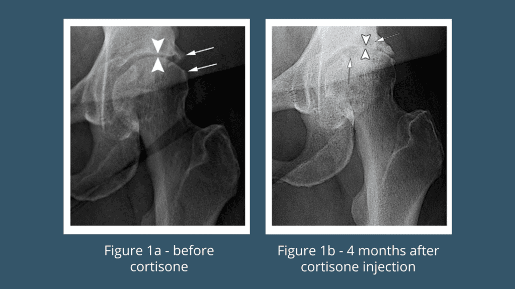 Risks of Cortisone Shots & How to Make it Worthwhile Precision Movement